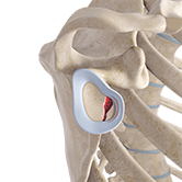 Shoulder Joint Tear (Glenoid Labrum Tear) Image