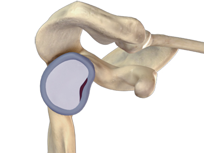 Shoulder Joint Tear (Glenoid Labrum Tear) - Educational Picture