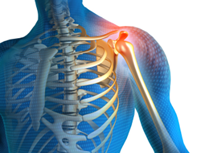 Shoulder Pain - Educational Picture