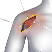 Shoulder Surgery