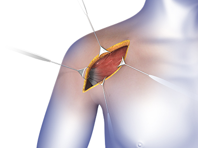 Shoulder Surgery - Educational Picture