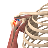 Shoulder Tendonitis Image