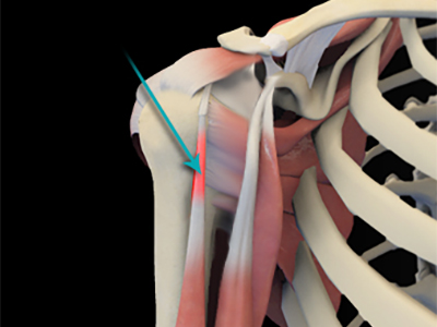 Shoulder Tendonitis - Educational Picture