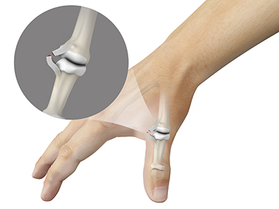 Skier's Thumb - Educational Picture