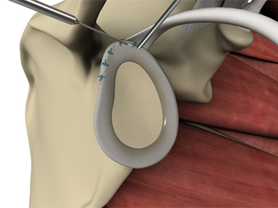 Slap Repair - Educational Picture