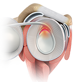SLAP Tears Image