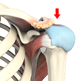 Subacromial Decompression