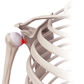 Subluxation (Shoulder) Image