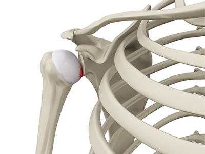 Subluxation (shoulder) - Educational Picture