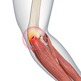 Tennis Elbow Surgery Image