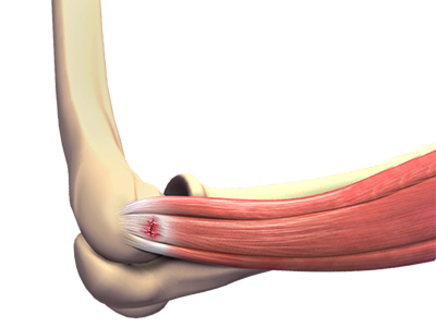 Tennis Elbow Treatment - Educational Picture