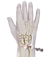 TFCC Repair (Open and Arthroscopic) Image