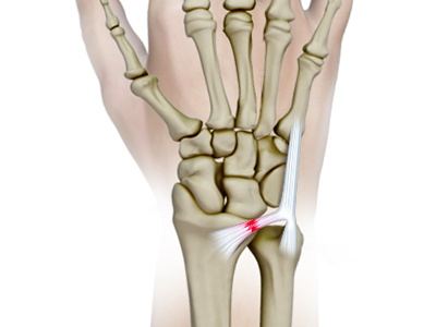 TFCC Repair (Open and Arthroscopic) - Educational Picture