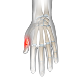 Thumb Fracture Image