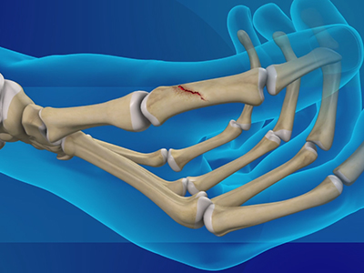 Thumb Fracture - Educational Picture