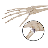 Thumb Joint Implant Image