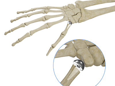 Thumb Joint Implant - Educational Picture