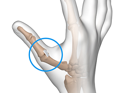 Thumb UCL Injury - Educational Picture