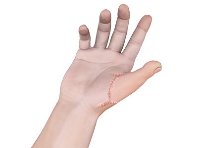 Toe to Hand Transfer - Educational Picture
