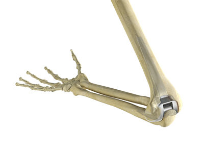 Total Elbow Replacement - Educational Picture