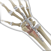 Total Wrist Arthrodesis Image