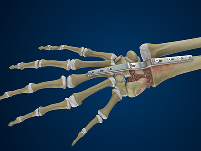 Total Wrist Arthrodesis - Educational Picture