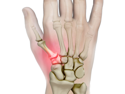 Trapeziometacarpal (TMC) Arthritis - Educational Picture