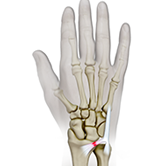 Triangular Fibrocartilage Complex Injury (TFCC) Image