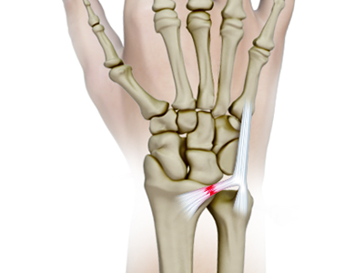 Triangular Fibrocartilage Complex Injury (TFCC) - Educational Picture