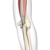 Triceps Repair Image