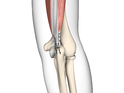 Triceps Repair - Educational Picture