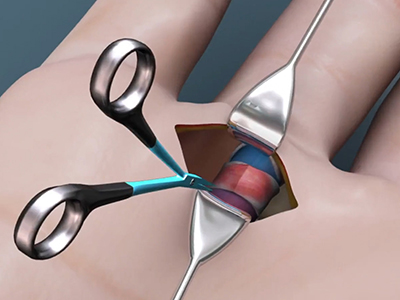 Trigger Finger Release - Educational Picture