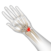 Triquetrolunate Instability Image