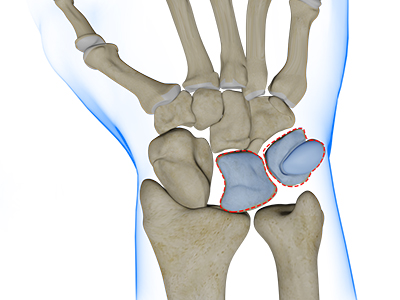 Triquetrolunate Instability - Educational Picture