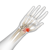 Triscaphoid Joint Arthritis Image