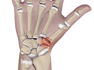 Triscaphoid Joint Arthritis - Educational Picture