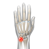 Ulnar Carpal Impaction Image