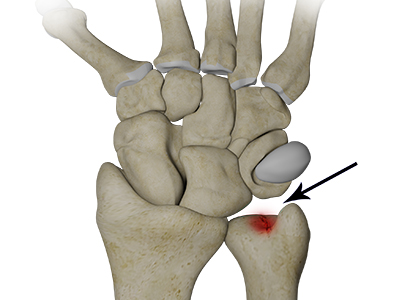 Ulnar Carpal Impaction - Educational Picture