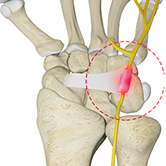 Ulnar Nerve Compression in Guyon's Canal Image