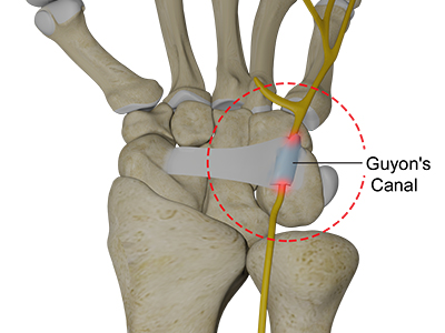 Ulnar Nerve Compression in Guyon's Canal - Educational Picture
