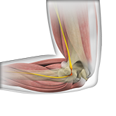 Ulnar Nerve Entrapment at the Elbow (Cubital Tunnel Syndrome) Image
