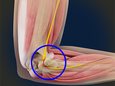 Ulnar Nerve Entrapment at the Elbow (Cubital Tunnel Syndrome) - Educational Picture