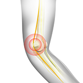 Ulnar Nerve Neuropathy Image