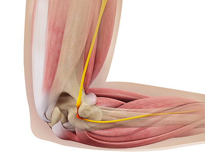 Ulnar Nerve Neuropathy - Educational Picture