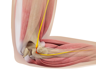Ulnar Nerve Release - Educational Picture