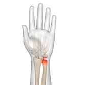 Ulnar Wrist Pain Image