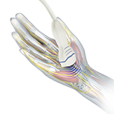 Ultrasound Guided Carpal Tunnel Release Image