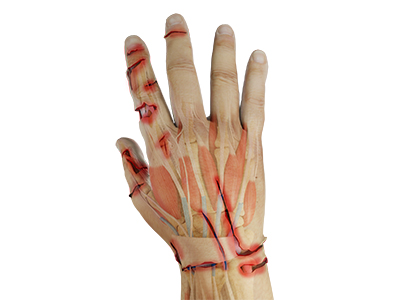 Upper Extremity Crush Injuries - Educational Picture