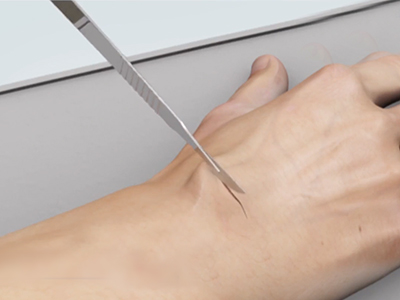 Wide-Awake Hand Surgery - Educational Picture
