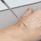 Wide-Awake Hand Surgery Image